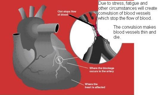 heart attack pain. Heart Convulsion