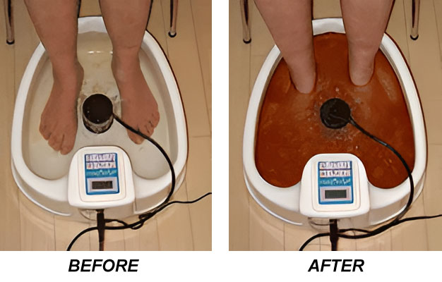 Ionic Foot Detox Bath Machine (Before and After)