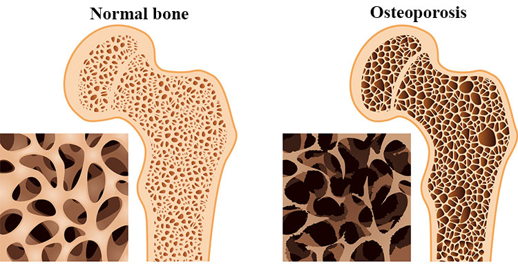 Normal bone and Osteoporosis comparison