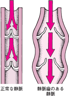 Varicose Veins