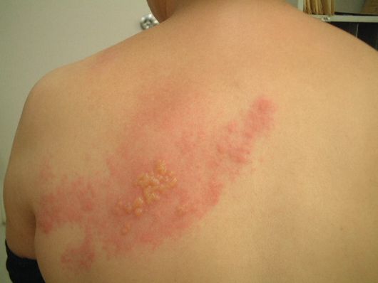 herpes pictures. Herpes Zoster (Shingles)