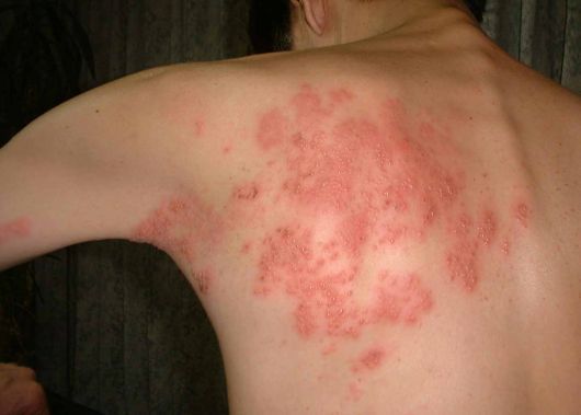signs of herpes. Herpes zoster is caused by the