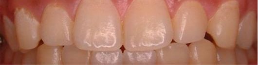How do you restore tooth enamel?
