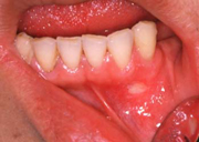 Canker Sore