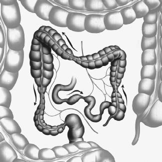 Irritable Bowel Syndrome