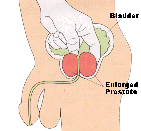 Prostate Enlargement