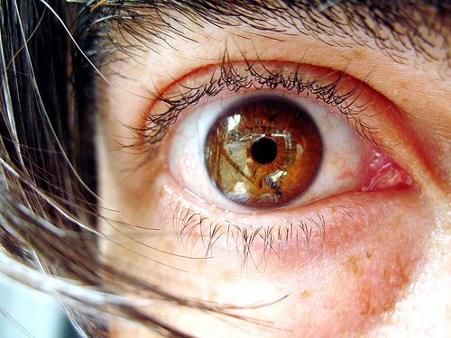 Infection with the Use of Contact Lenses