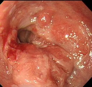 Esophageal Cancer