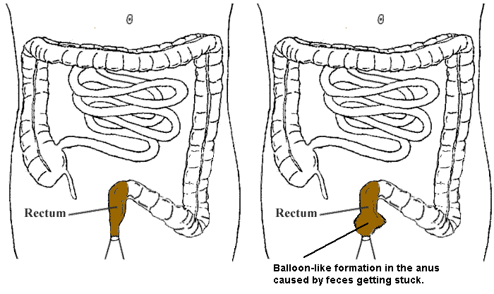 Stuck feces on the rectum