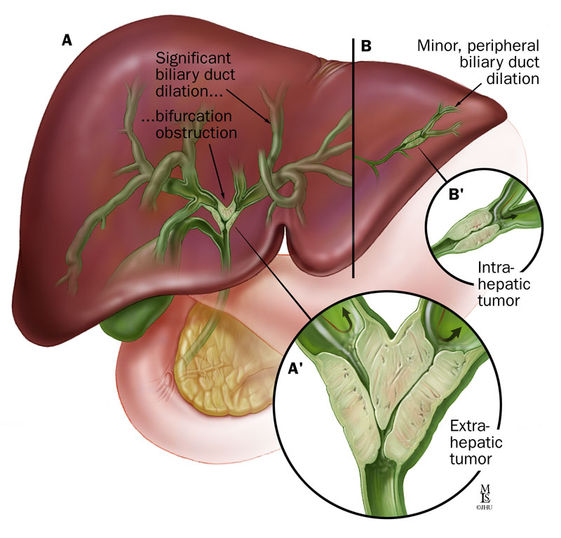 Bile Duct Cancer