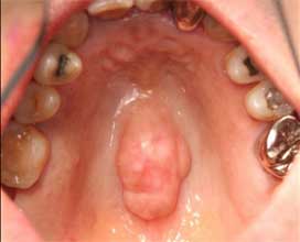 Bruxism causing bony ridge