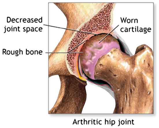 Worn-out cartilage in Hip Joint