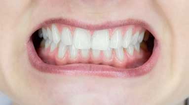 Bruxism - Teeth Clenching