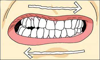 Bruxism - Teeth Grinding