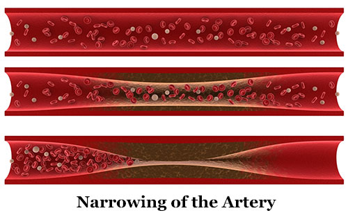 Arteriosclerosis (narrowing of the artery)
