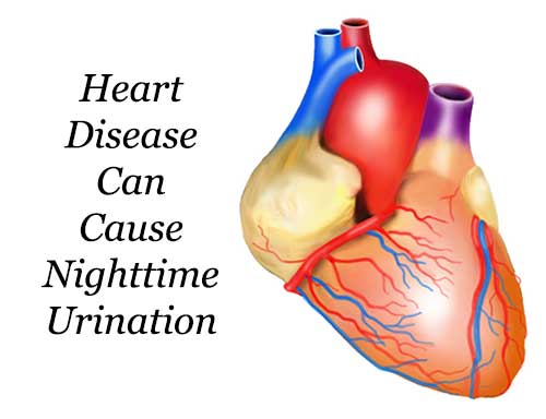 Heart disease can cause Nighttime urination