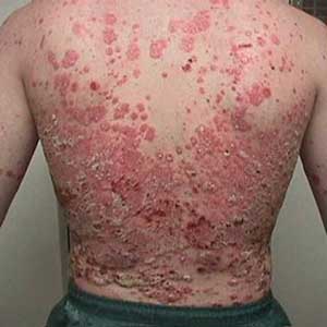 Scalp Psoriasis