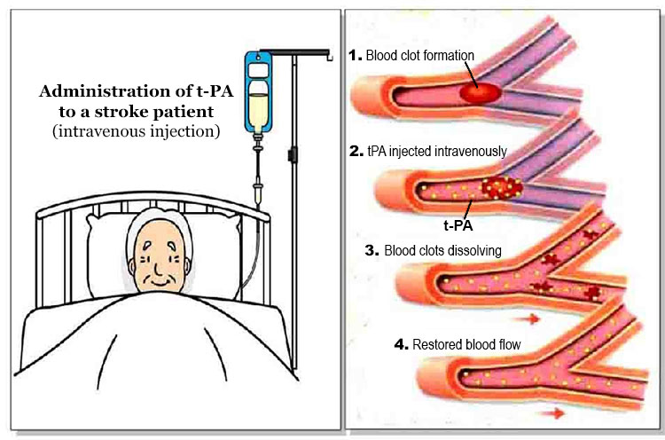 t-PA Intravenous Therapy