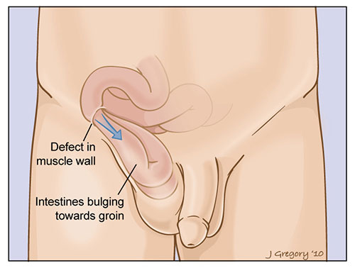 Illustration on how Inguinal Hernia develops