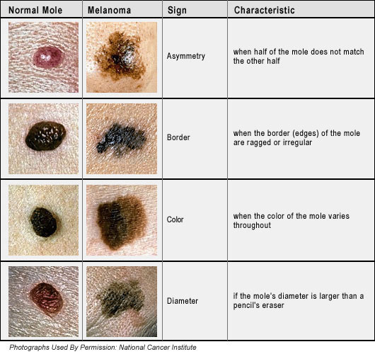 How do you find pictures of abnormal skin moles?