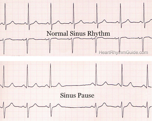 Comparison between Normal Sinus Rhythm and Sinus Pause