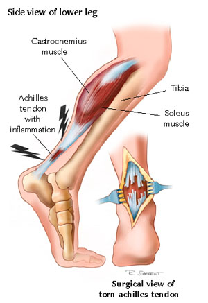 Achilles Tendon Rupture