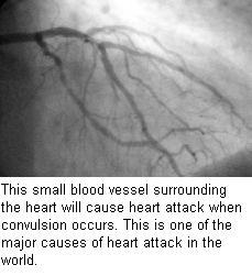 Angiogram