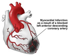 Myocardial Infarction