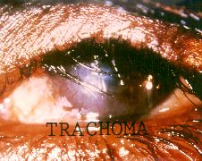 Trachoma
