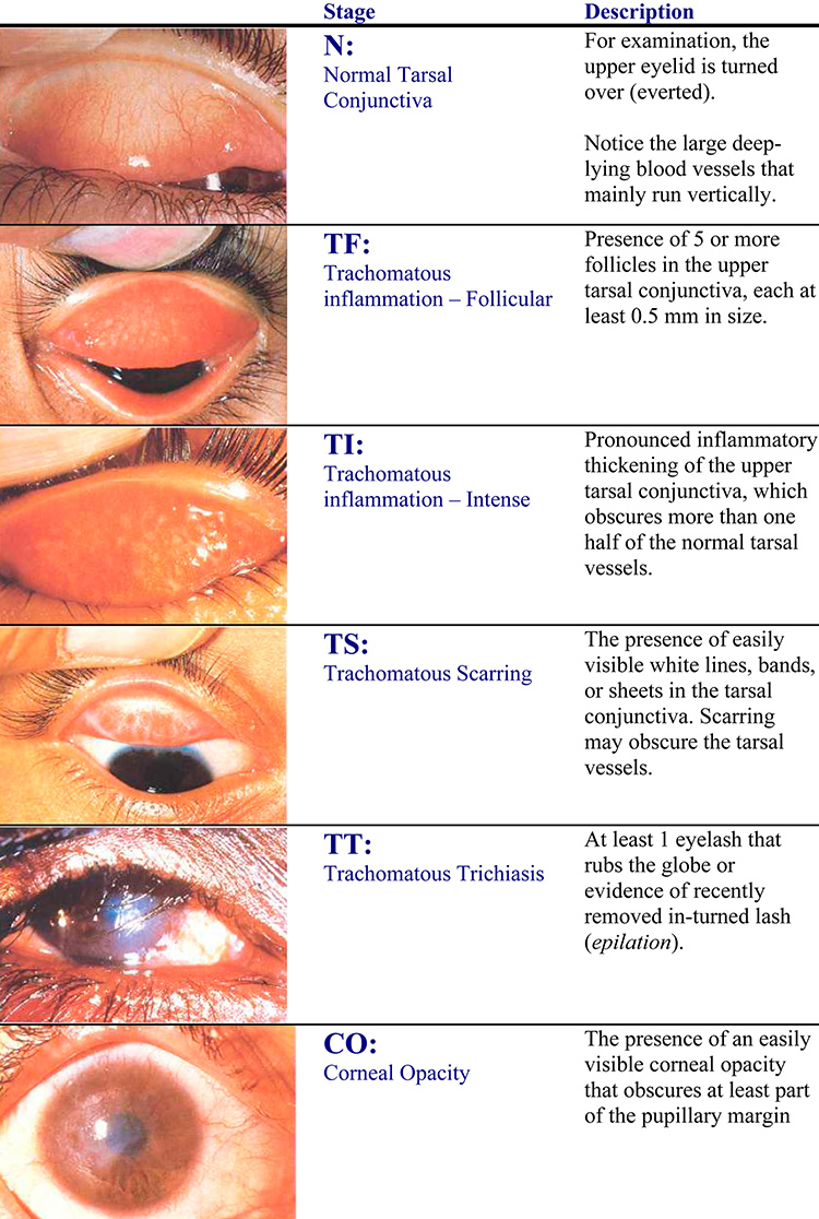 Trachoma