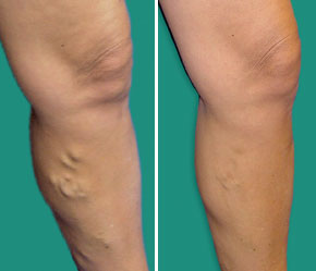 Varicose Veins