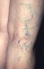 Varicose Veins