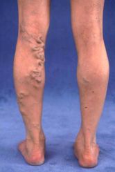 Varicose Veins