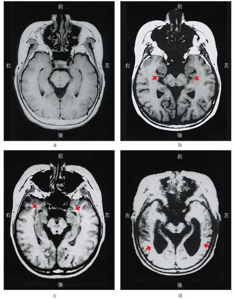 Alzheimer's Disease Brain