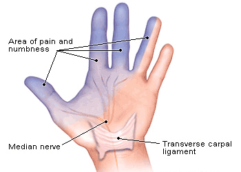 Carpal Tunnel Syndrome