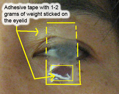 Eyelid Lifting