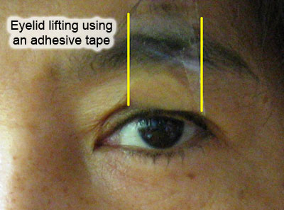 Eyelid Lifting