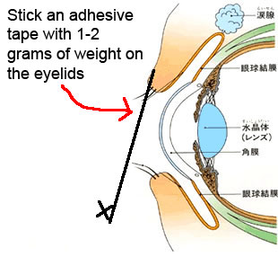 Eyelid Lifting