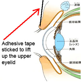 Eyelid Lifting