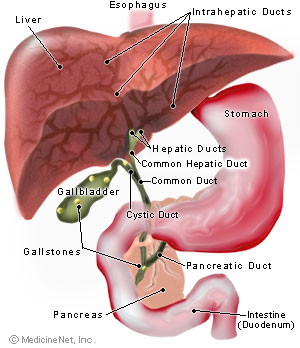 Gallstones