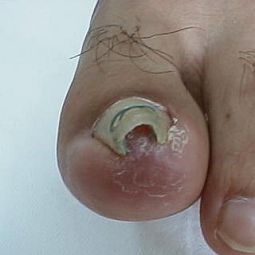 Ingrown Toenails