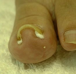 Ingrown Toenails