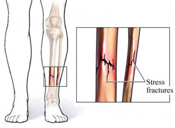 Stress Fractures