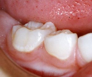 Tooth Enamel