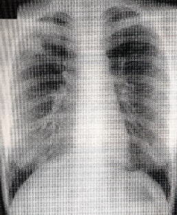 Tuberculosis