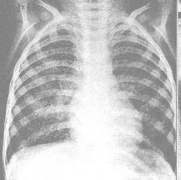 Tuberculosis