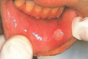 Aphthous Ulcer