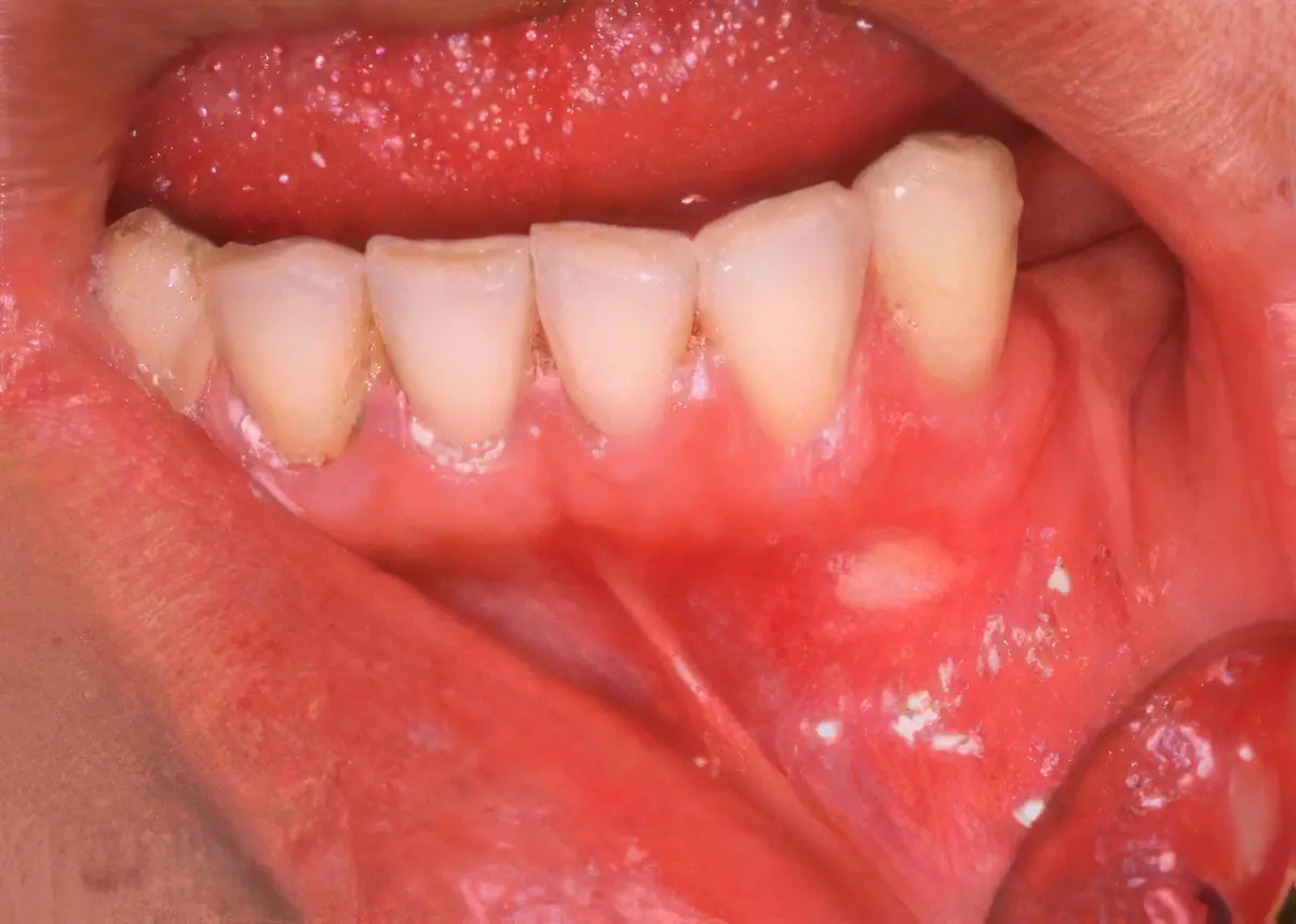 Canker Sore - Mouth Ulcer