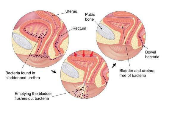 Cystitis