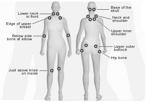 Fibromyalgia 18 tender points diagnosis